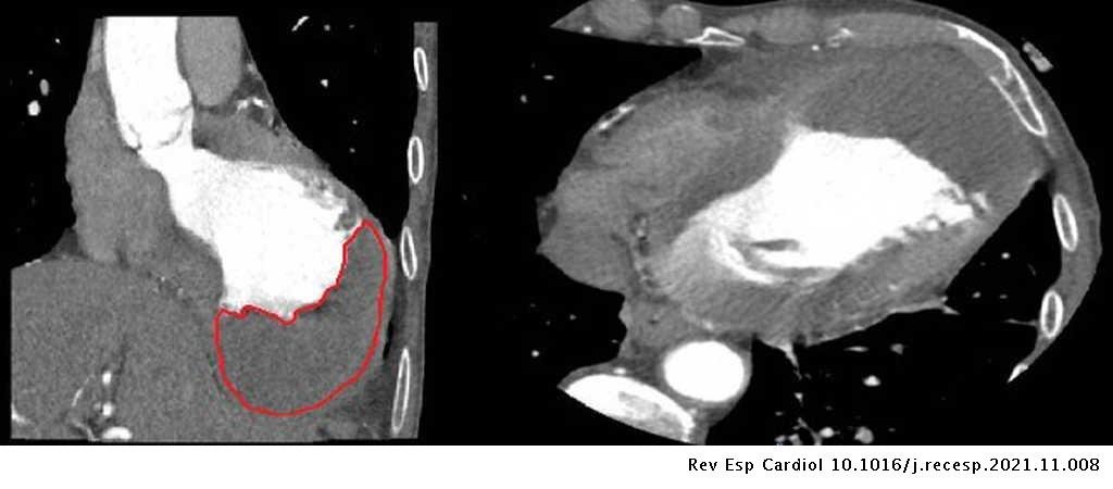 REC Publications (@revespcardiol) on Twitter photo Apixabán y resolución de trombo intraventricular en un paciente con IAM #REC #AheadOfPrint #Cardiotwitter <a href="/anguita_m/">Manuel Anguita</a> ow.ly/4Etb50HeZ10 Apixabán y resolución de trombo intraventricular en un paciente con IAM #REC #AheadOfPrint #Cardiotwitter <a href="/anguita_m/">Manuel Anguita</a> ow.ly/4Etb50HeZ10