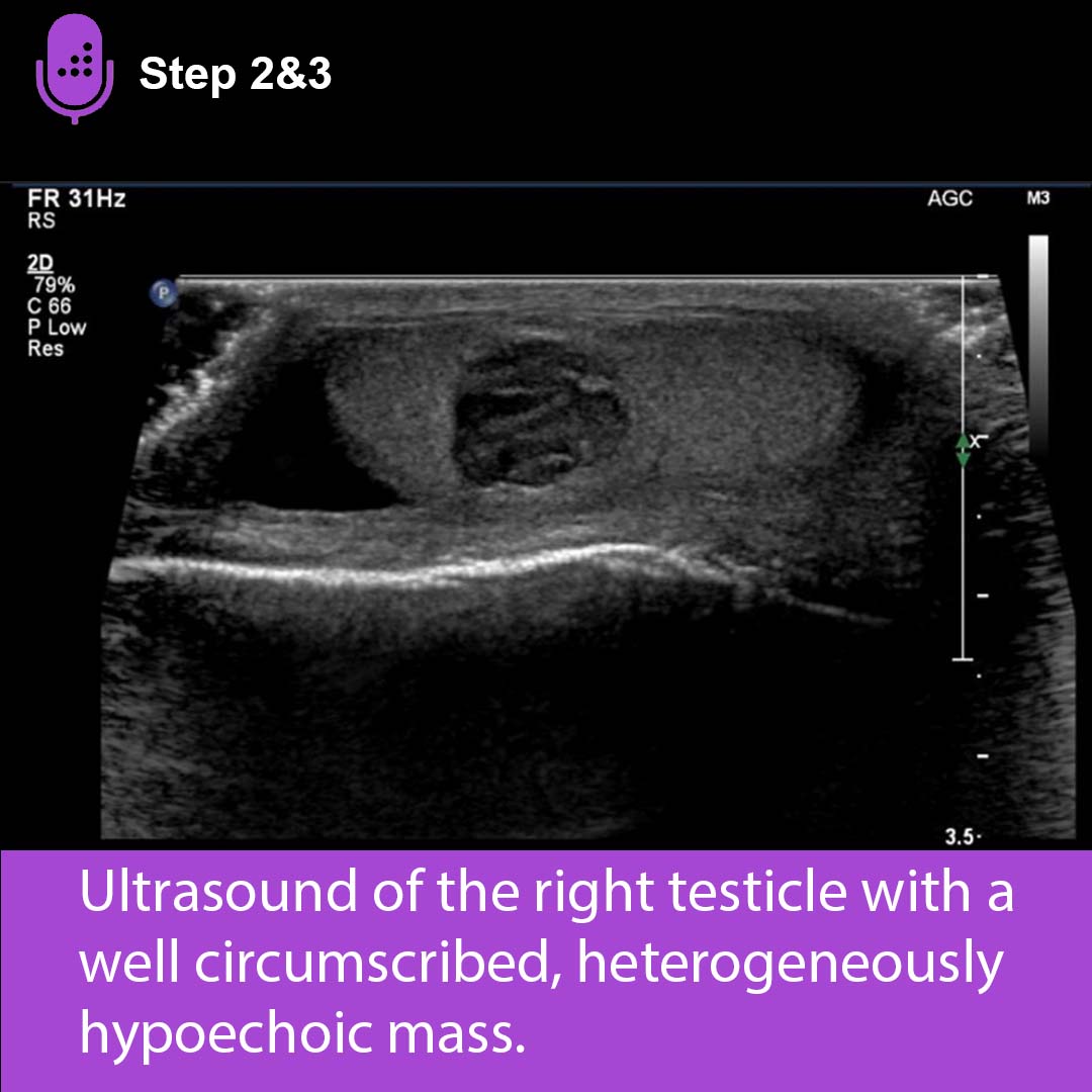 medbullets's tweet photo. Negative feedback from increased testosterone results in low luteinizing and follicle stimulating hormones in Leydig cell tumors.
Learn more about Testicular Cancer on our DAILY #USMLE Step 2 & 3 podcast. #medtwitter #medschool #mestudent https://t.co/ngo9uXDaF1 https://t.co/Fi9lWJngss