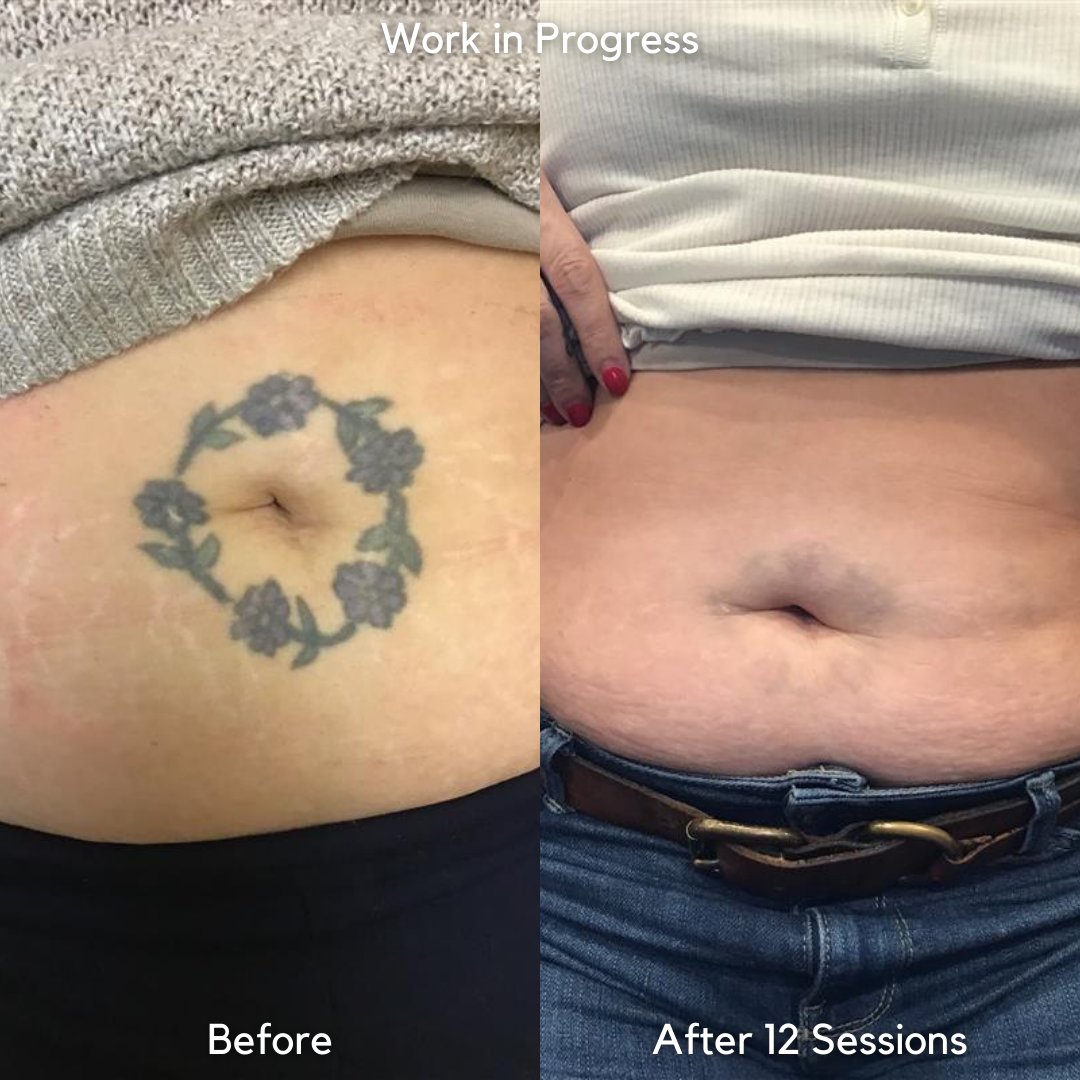 Laser Tattoo Removal On Womans Stomach Stock Photo  Alamy