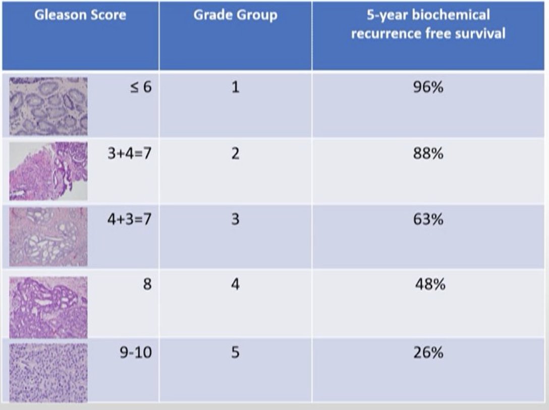 Adverse #ProstateCancer pathological variants: considerations for management. Presentation by @JGordetsky @VUMCPathology. #SUO21 written coverage by <a href="/WallisCJD/">Christopher Wallis (he/him/his)</a> <a href="/UofT/">University of Toronto</a> on UroToday > bit.ly/3GD0hlh <a href="/UroOnc/">Society of Urologic Oncology</a>