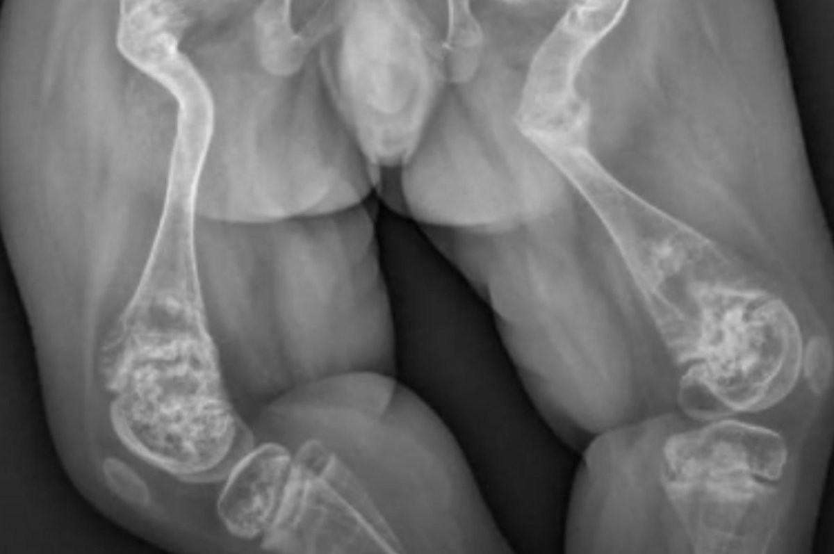 The diagnosis is osteogenesis _______.  Answer = ow.ly/Mcvc50HiFKA
