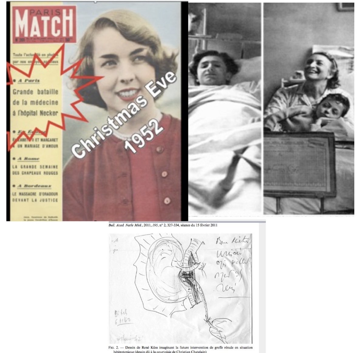 #onthisday, 69 years ago, the world’s first living donor kidney transplantation was performed at <a href="/hopital_necker/">Hôpital Necker AP-HP</a> 🇫🇷with Gilberte Renard giving her kidney to her son Marius.
Nephrectomy surgeon: Delinotte
Transplant urologists: Vaysse and Oeconomos
Head nephrol: Jean Hamburger