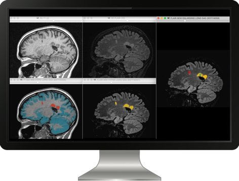 MSwebNL's tweet photo. Digitale technologie helpt arts en patiënt: https://t.co/6sGjIDBYkY #MS #MSweb Het beoordelen van MRI-scans is een belangrijke taak bij de behandeling van MS. Radiologen bekijken de scans en op basis van hun rapport nemen neurologen – in samenspraak met de patiënt – belangrijke.. https://t.co/6qJQRQ9bw2
