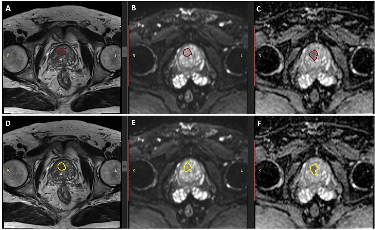 📄 New article: MRI #Radiomics in #ProstateCancer: A Reliability Study

👨‍⚕️👩‍⚕️ <a href="/FabrizioUrraro/">Fabrizio Urraro</a>, <a href="/Valerio_Nardone/">VNardone</a> et al.

Read here 👉 fro.ntiers.in/uEHD

 #PCsm #GUsm #UroSoMe #UroOnc #Oncology #Imaging