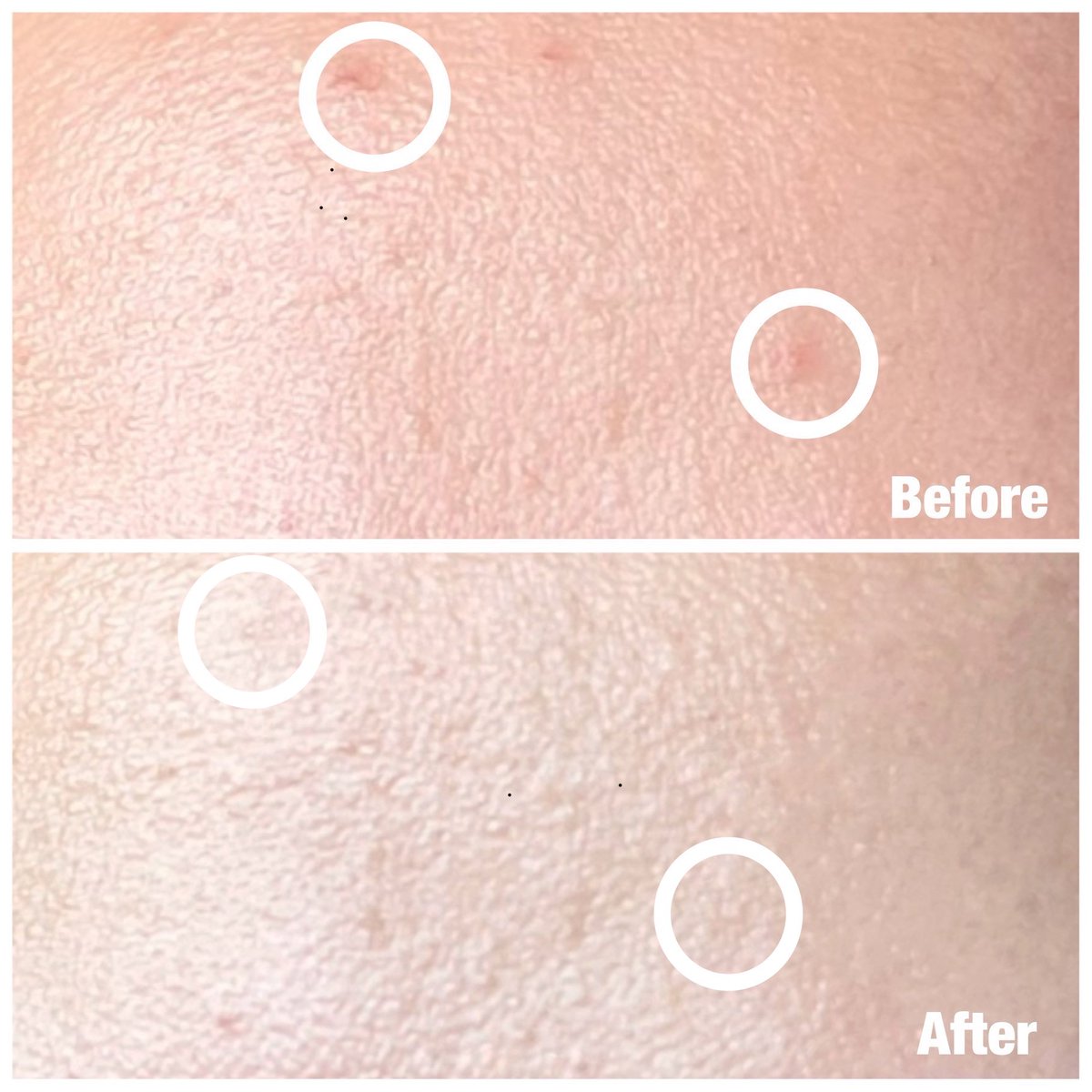 มันปังว่ะ #NIVEAAcneRepair เป็นไลน์ที่มาจัดการสิว ละคือเค้าดีตั้งแต่คลีนซิ่งสูตรน้ำ บางเบา ไม่เหนอะหนะ ทำความสะอาดดี ตัวล้างหน้าก็อ่อนโยน ช่วยลดแบคทีเรียตั้งแต่ล้างปิดงานด้วยเซรั่มซอง ลดสิวอักเสบ ช่วยให้ผิวแข็งแรง เป็นเซ็ตอเวนเจอร์ปราบสิวของนีเวียเว่อออ ปังนะ #ส่งสิวสู่ขิต แล้ว1