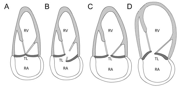 Reviews in Cardiovascular Medicine (@rcmjournal) on Twitter photo 🎄🔊#RCM - Vol. 22 No. 4 (6/62)
💎Review
#Etiology, #epidemiology, #pathophysiology and management of #TricuspidRegurgitation: an overview
<a href="/fracond_94/">Francesco Condello</a> <a href="/GGStefanini/">Giulio Stefanini</a> <a href="/mauro_gitto/">Mauro Gitto</a>
rcm.imrpress.com/EN/10.31083/j.… 🎄🔊#RCM - Vol. 22 No. 4 (6/62)
💎Review
#Etiology, #epidemiology, #pathophysiology and management of #TricuspidRegurgitation: an overview
<a href="/fracond_94/">Francesco Condello</a> <a href="/GGStefanini/">Giulio Stefanini</a> <a href="/mauro_gitto/">Mauro Gitto</a>
rcm.imrpress.com/EN/10.31083/j.…