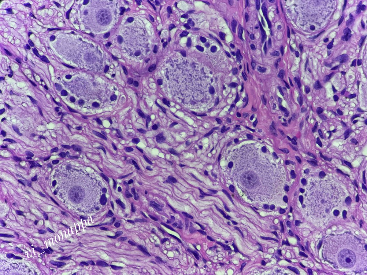 vi_monappa's tweet photo. Found this in peri thyroidal tissue #pathtwitter #histology #normaltissue #pathresidents Can u tell what it is u see? https://t.co/W4UUVVE5oj