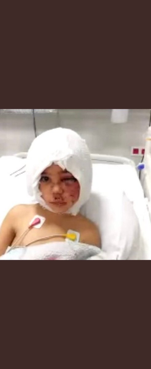 Kınadık,rahatladık 
Ya sonra?
Bir çocuğu
hayatı boyunca yakasına yapışan travmaya,bir dizi ameliyata mahkum ettik!
Bir şuursuzun egosunu,keyfini tatmin etmesinin bedeline mahkum ettik!
Bu cinayete teşebbüs!
Ah
#Asiye 
Yüreğim dağlandı bakışlarına
OLMAYACAK MI BUNUN BEDELİ/ÖNLEMİ?