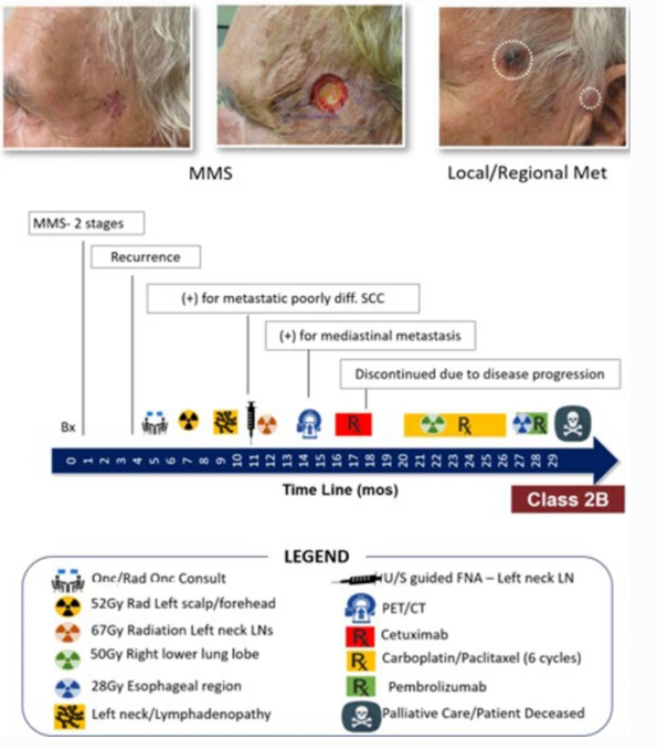 DermatolTher's tweet photo. Clinical Utility of the 40-Gene Expression Profile Test for Improved Patient Management Decisions and Disease-Related Outcomes when Combined with Current Clinicopathological Risk Factors for Cutaneous #SquamousCellCarcinoma: https://t.co/zyWdaENF01 #GeneExpressionProfiling https://t.co/jAnP40eNqj