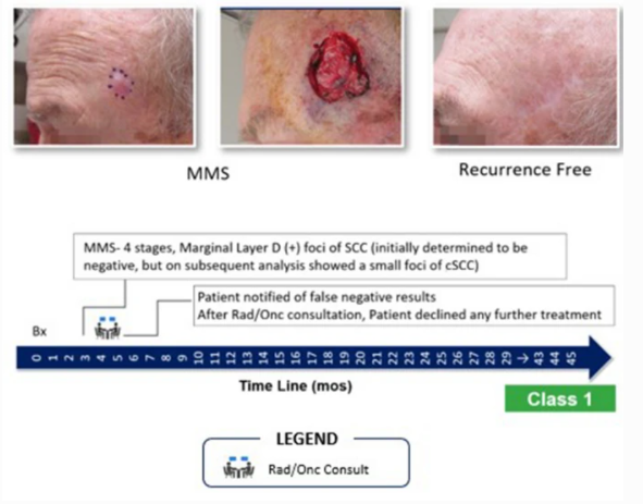 DermatolTher's tweet photo. Clinical Utility of the 40-Gene Expression Profile Test for Improved Patient Management Decisions and Disease-Related Outcomes when Combined with Current Clinicopathological Risk Factors for Cutaneous #SquamousCellCarcinoma: https://t.co/zyWdaENF01 #GeneExpressionProfiling https://t.co/jAnP40eNqj