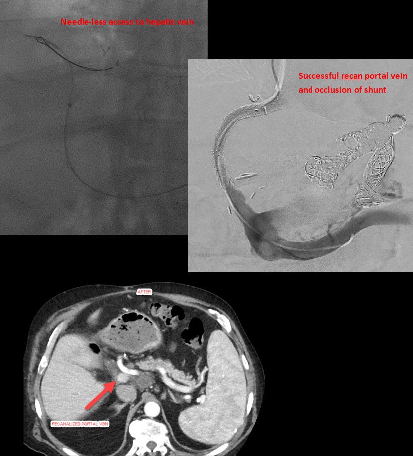 University of Cincinnati Interventional Radiology (@uc_vir) on Twitter photo Portal vein recanalization and embolization of large portal-systemic shunt for a patient with liver transplant complicated by PV thrombosis with severe hepatic encephalopathy. HE resolved with maintained liver function. With Dr. Makramalla <a href="/AMakramalla/">Abouelmagd Makramalla</a> <a href="/UCRadRes/">UCRadRes</a> <a href="/SIRspecialists/">Society of Interventional Radiology</a> Portal vein recanalization and embolization of large portal-systemic shunt for a patient with liver transplant complicated by PV thrombosis with severe hepatic encephalopathy. HE resolved with maintained liver function. With Dr. Makramalla <a href="/AMakramalla/">Abouelmagd Makramalla</a> <a href="/UCRadRes/">UCRadRes</a> <a href="/SIRspecialists/">Society of Interventional Radiology</a>