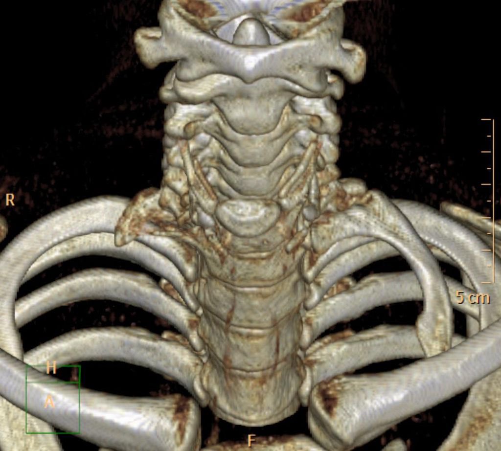 editionsjpl's tweet photo. LE SAVIEZ-VOUS ?

Le syndrome de Naffziger ou le syndrome de la côte cervicale ou du scalène antérieur est un ensemble de symptômes caractérisés par l'existence d'une côte cervicale supplémentaire. https://t.co/ez4Z8fvXsv
