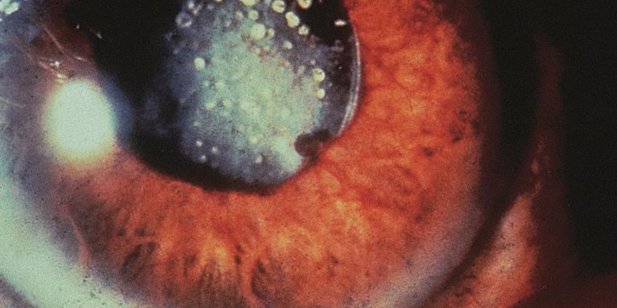 Christmas tree #cataracts are associated with #MyotonicDystrophy, and snowflake cataracts are associated with #diabetes. Review current recommendations for the work-up of cataracts in children.  ow.ly/lnZj50H399f #pediatricophthalmology