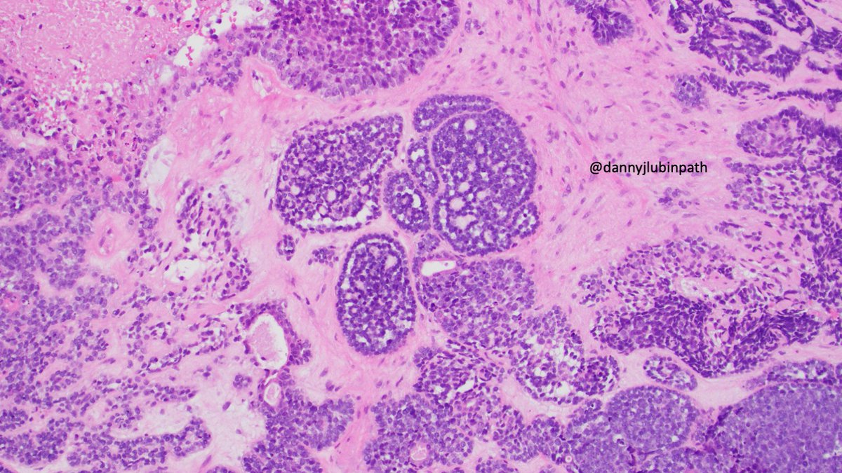 NASHNPath's tweet photo. Happy Friday everybody!
Here's a holiday treat shared by @dannyjlubinpath.

Middle aged pt with a sinonasal mass. 
What ancillary testing might you pursue to arrive at the correct diagnosis? https://t.co/55GYXuCWBP