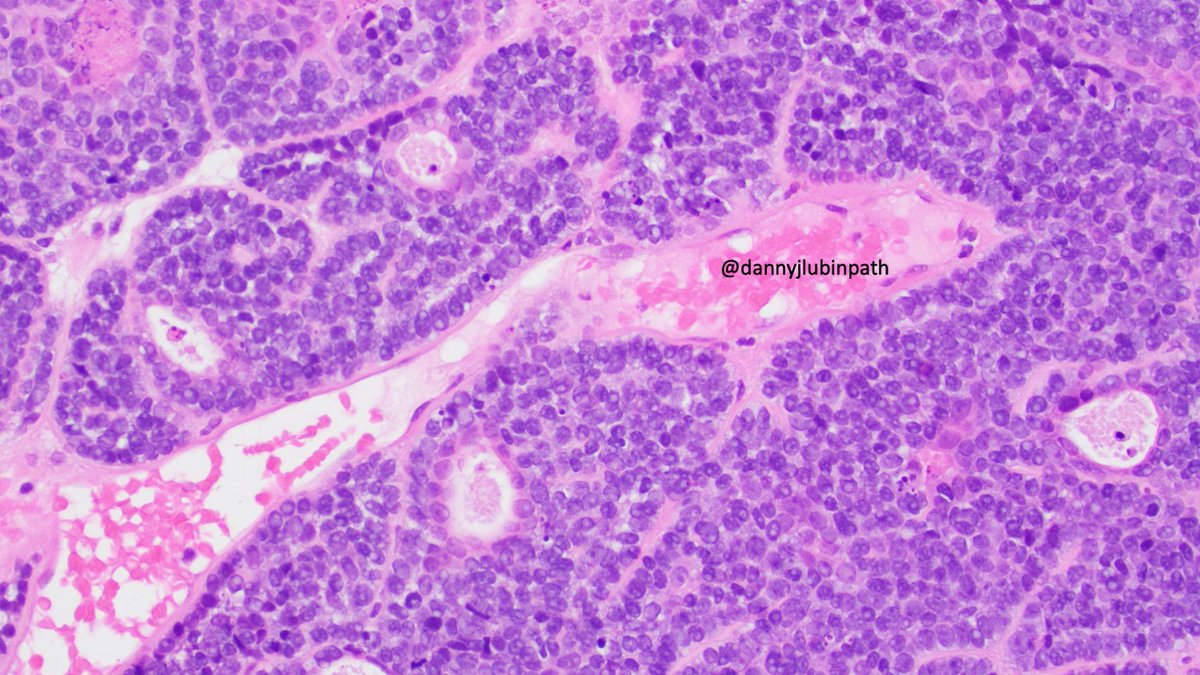 NASHNPath's tweet photo. Happy Friday everybody!
Here's a holiday treat shared by @dannyjlubinpath.

Middle aged pt with a sinonasal mass. 
What ancillary testing might you pursue to arrive at the correct diagnosis? https://t.co/55GYXuCWBP