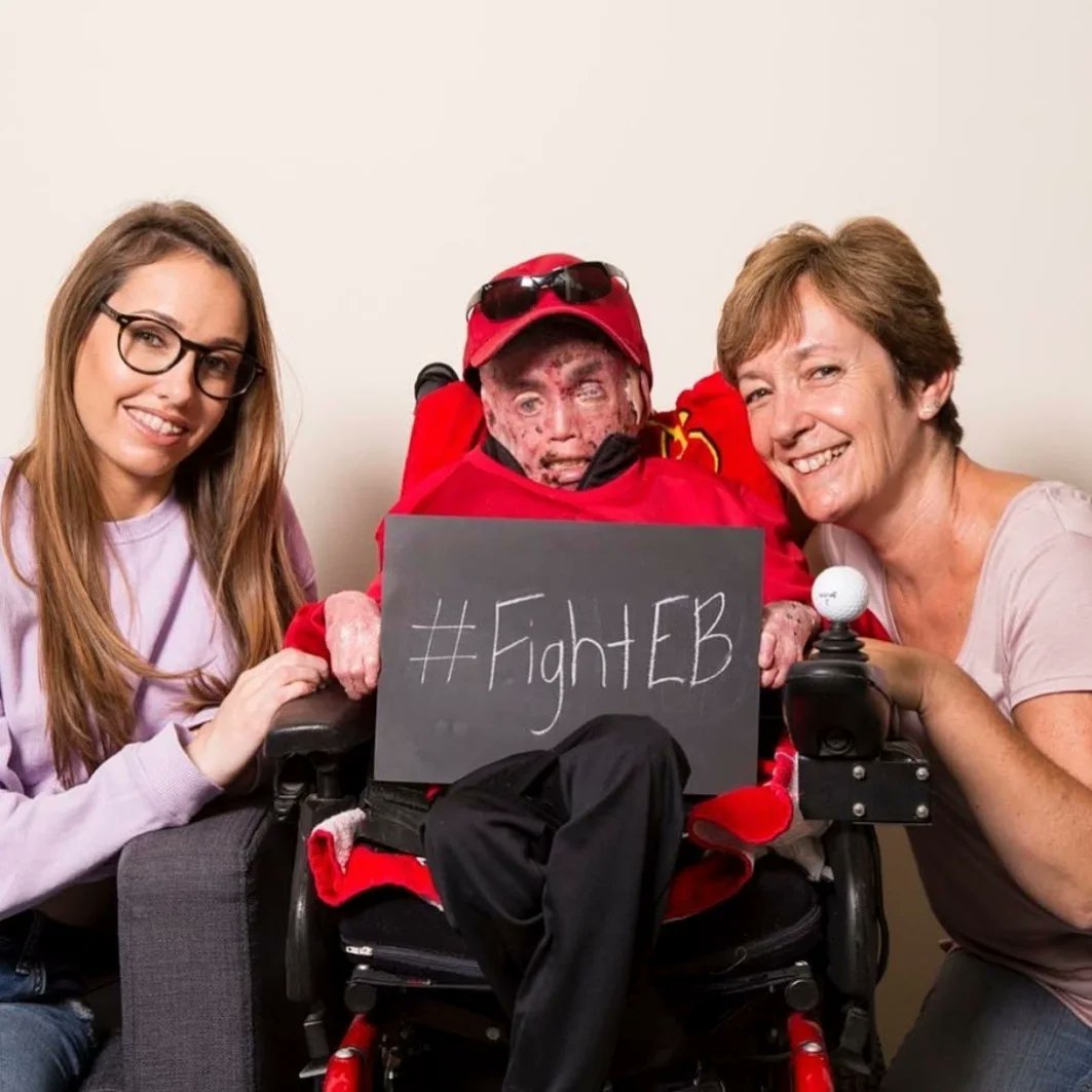 CharityDEBRA's tweet photo. RIP Oliver Michael Thomas 1989-2021.

After bravely battling EB all his life, and cancer for the last two years, Oliver passed away peacefully in his sleep, on Tuesday afternoon. 

Oliver was a great supporter of DEBRA and our heartfelt sympathy goes out to the Thomas family. https://t.co/jIUCQiU0z3