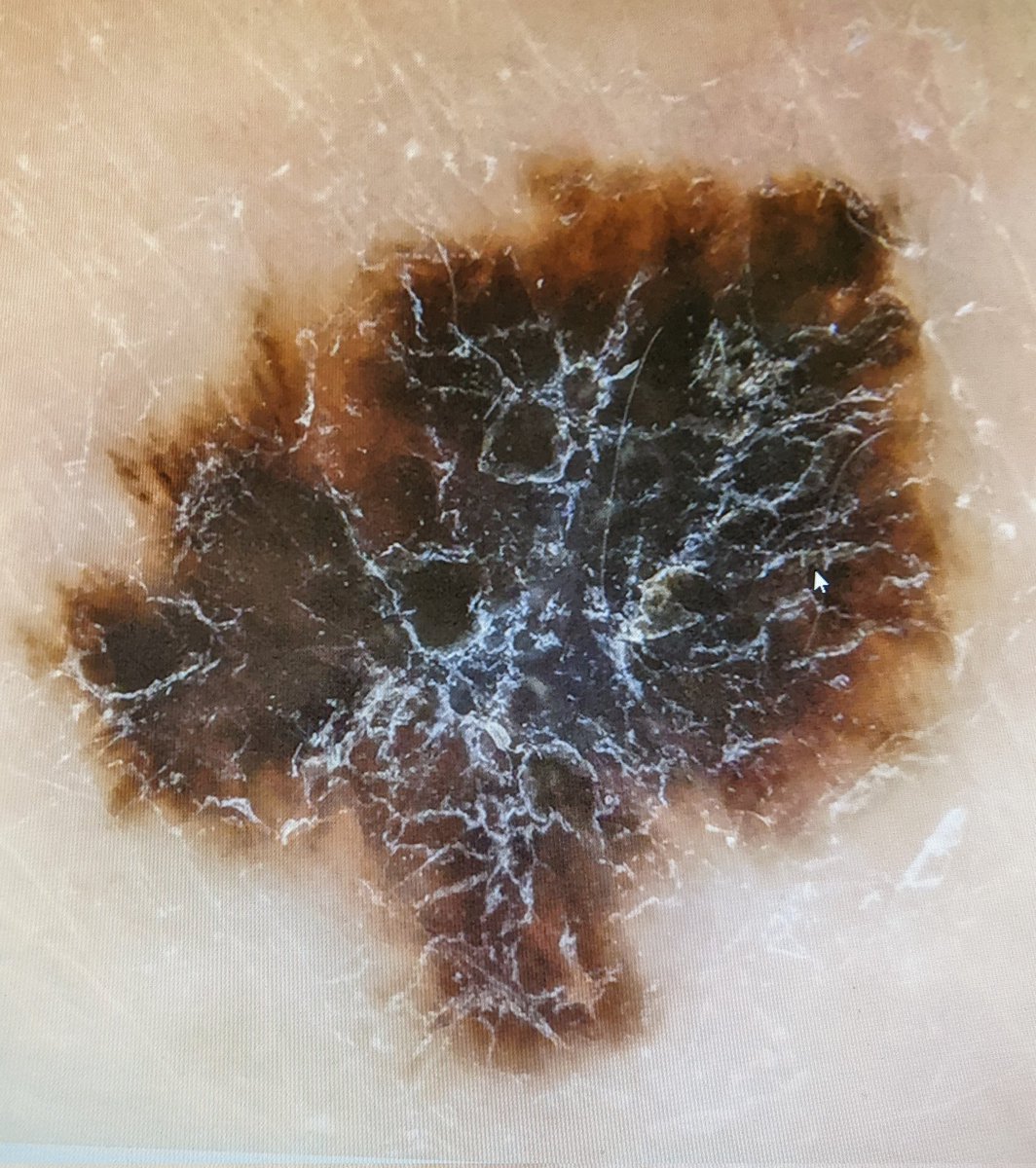 Ian Lalsingh (@ian_lalsingh) on Twitter photo Still thinking about #getvaccinated #getboosted? Please do so... you may be very glad you did.
Unusual mole noted on patients arm when getting booster #dermoscopy + referred.
Booked straight for excision of a melanoma
Great treatment by dermatology <a href="/NHSCTrust/">Northern Trust</a> patient v grateful Still thinking about #getvaccinated #getboosted? Please do so... you may be very glad you did.
Unusual mole noted on patients arm when getting booster #dermoscopy + referred.
Booked straight for excision of a melanoma
Great treatment by dermatology <a href="/NHSCTrust/">Northern Trust</a> patient v grateful