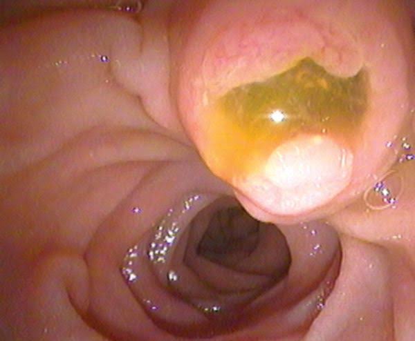 dralgazar's tweet photo. @mpauforero Fish eye sign which is pathognomonic for Intraductal papillary mucinous neoplasm https://t.co/aOPZMiMNGX