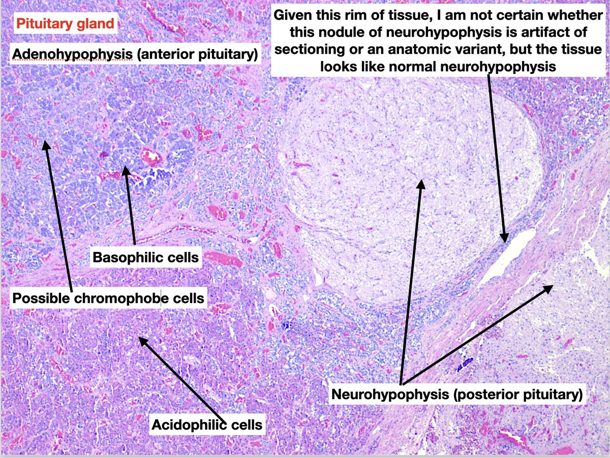 #MTPathUnknown #256 Answer
Explanatory slide 1/2
<a href="/MaryMathew77/">Mary Mathew</a> <a href="/pathology98/">pathology98</a> <a href="/Jas_Bod/">Yasmine Buderbala</a> Good ID
@JulianBurton15 I really enjoyed your fantastic reply!
I just thought this image nicely portrayed the histologic features of the pituitary gland from low power for students