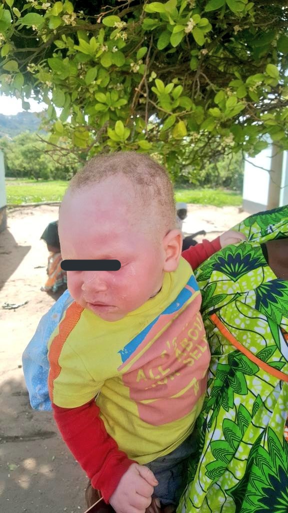 The_Tonga_Queen's tweet photo. Meet baby Emmanuel, from Mutoko, his skin is physically affected by lack of sunlotions. As l recieved his picture l was touched, l dont know Zimbabwe lets make Christmas great for Emmanuel. I have arranged a sunhat and 6 months supply of lotions to him. Let donate to Emmanuel ❤️ https://t.co/5OyPfoz6Ky