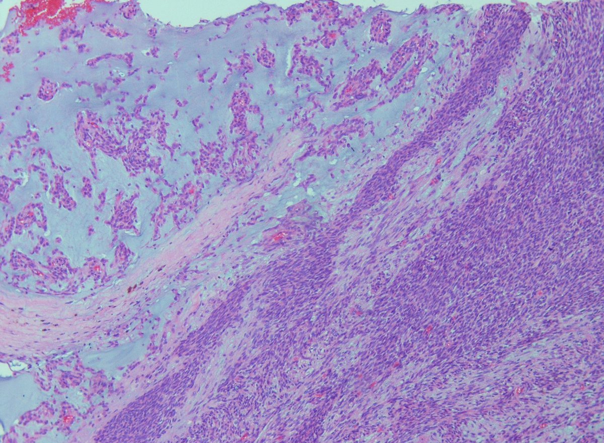 pouyanshakib's tweet photo. Right facial swelling of parotid area in a 45 y/o female.
#PanCK #p63 IHC staining
Myoepithelial carcinoma Ex- pleomorphic adenoma?
#pathology #oralpath https://t.co/WBVJBxWgHz