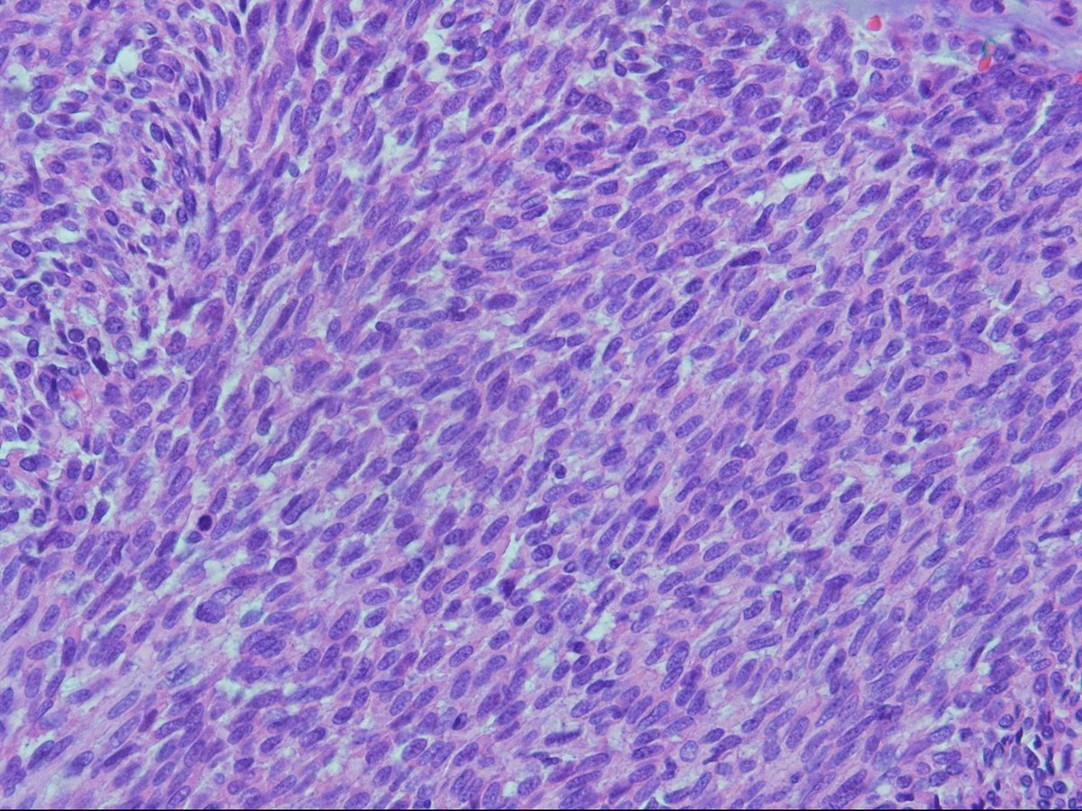 pouyanshakib's tweet photo. Right facial swelling of parotid area in a 45 y/o female.
#PanCK #p63 IHC staining
Myoepithelial carcinoma Ex- pleomorphic adenoma?
#pathology #oralpath https://t.co/WBVJBxWgHz