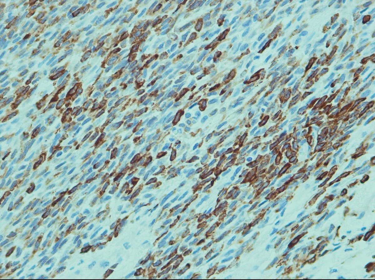pouyanshakib's tweet photo. Right facial swelling of parotid area in a 45 y/o female.
#PanCK #p63 IHC staining
Myoepithelial carcinoma Ex- pleomorphic adenoma?
#pathology #oralpath https://t.co/WBVJBxWgHz