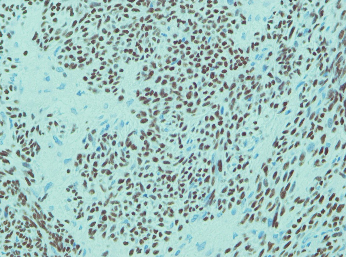 pouyanshakib's tweet photo. Right facial swelling of parotid area in a 45 y/o female.
#PanCK #p63 IHC staining
Myoepithelial carcinoma Ex- pleomorphic adenoma?
#pathology #oralpath https://t.co/WBVJBxWgHz