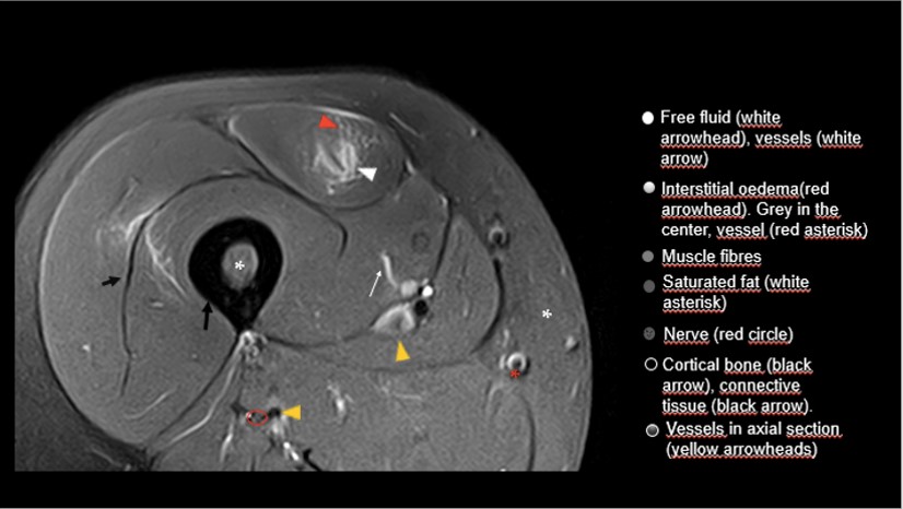 BJSM_BMJ's tweet photo. Do you struggle with musculoskeletal MRI? 🙋‍♀️🙋‍♂️💪

This beginner's guide to interpretation might just be the best Christmas present you receive all day!🎄🎁

➡️ https://t.co/YnyQcnUkvt https://t.co/bJMpoM3xYV