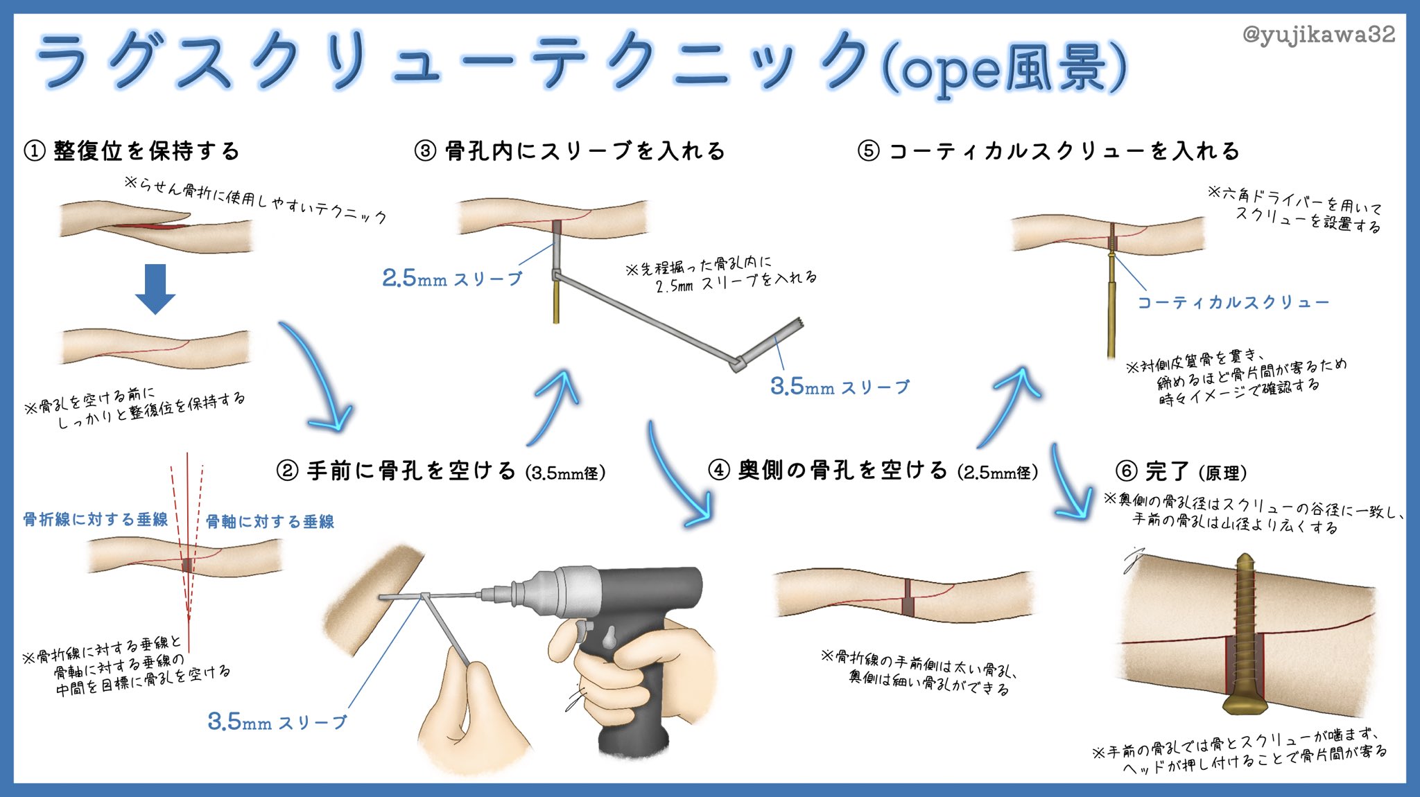 ユジカワ 整形dr イラストレーター 骨折手術時に多用するラグスクリューについてです 鎖骨骨折や外果骨折などでらせん骨折 の際に プレート固定前にこれで固定しておくと 強度も増すし整復位も綺麗に保持できる ラグスクリュー Opeイラスト日記