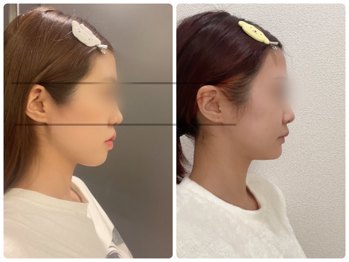 両顎＋輪郭3点 DT6ヶ月

長いようで早かったDTがやっと半年🌸
術後、DT過酷で不自由なことも多くて大変だったけど
顎変形症で適用なのもあって本当に手術してよかった🥲♡♡

一応DTは終わりだけどこれからも引き続き定期的にレポしてこうと思います🐇