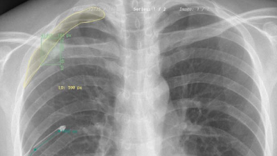 Radiology_AI's tweet photo. Presenting a large pneumothorax segmentation dataset! Publicly available anonymized dataset of 19,237 pneumothorax segmentation images https://t.co/zXWc0g3YCR @DSMOtago @AucklandUni @SijingF #ribFx #ribFracture #ML https://t.co/wJhAd3IDgE