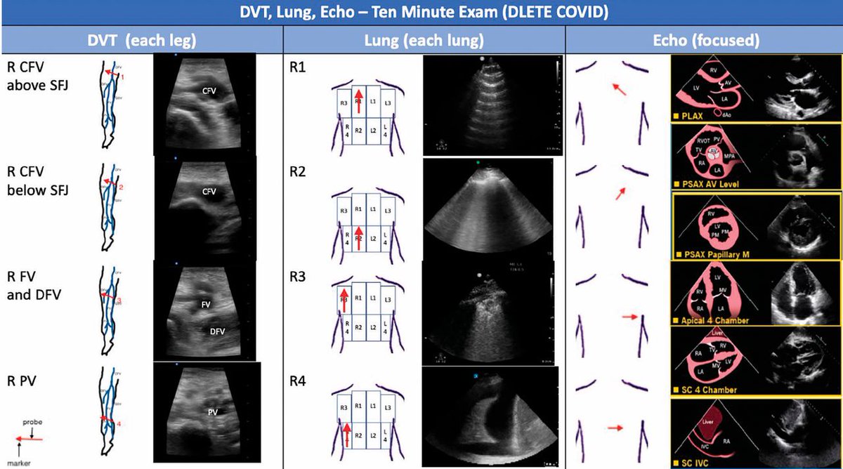 NephroPOCUS (@nephrop) on Twitter photo DLETE #COVID-19 #POCUS protocol by our friends at <a href="/ClevelandClinic/">Cleveland Clinic</a> (Pub May 2020)
<a href="/FoxStevenW/">Steve Fox</a> <a href="/siddharth_dugar/">Siddharth Dugar MD FCCM,FCCM,FASE</a>
🔗ccjm.org/content/early/…
#MedEd #IMPOCUS DLETE #COVID-19 #POCUS protocol by our friends at <a href="/ClevelandClinic/">Cleveland Clinic</a> (Pub May 2020)
<a href="/FoxStevenW/">Steve Fox</a> <a href="/siddharth_dugar/">Siddharth Dugar MD FCCM,FCCM,FASE</a>
🔗ccjm.org/content/early/…
#MedEd #IMPOCUS