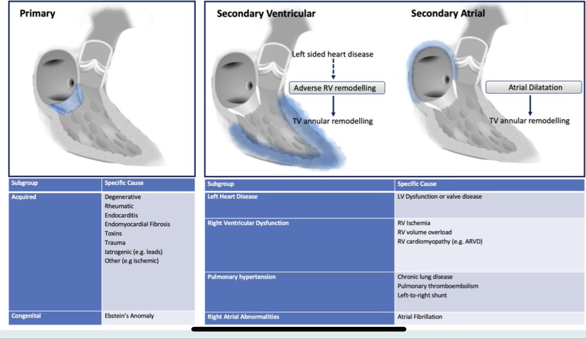 MARA Gavazzoni (@gavazzoni_mara) on Twitter photo At the end of the year : a great and comprehensive review on TV interventions is coming soon on line in EJHF. doi: 10.1002/ejhf.2398. Congratulation to <a href="/giuliorus/">Giulio Russo</a> and thanks to all this great team.
<a href="/denisamuraru/">Denisa Muraru</a> ,<a href="/m_taramasso/">Maurizio taramasso</a> ,<a href="/lpbadano/">Luigi</a>,<a href="/drmaisano/">francesco maisano</a>,<a href="/GennariMd/">Marco Gennari MD</a> At the end of the year : a great and comprehensive review on TV interventions is coming soon on line in EJHF. doi: 10.1002/ejhf.2398. Congratulation to <a href="/giuliorus/">Giulio Russo</a> and thanks to all this great team.
<a href="/denisamuraru/">Denisa Muraru</a> ,<a href="/m_taramasso/">Maurizio taramasso</a> ,<a href="/lpbadano/">Luigi</a>,<a href="/drmaisano/">francesco maisano</a>,<a href="/GennariMd/">Marco Gennari MD</a>