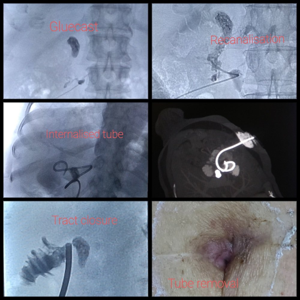 Interventional radiologic management of post surgery pancreatic fistula. 
Fistula internalised into jejunal loop. After maturation of the internal tract flow was diverted through the tract and cutaneous tract was closed by slow tube withdrawal leading to no further leak. 
#IR