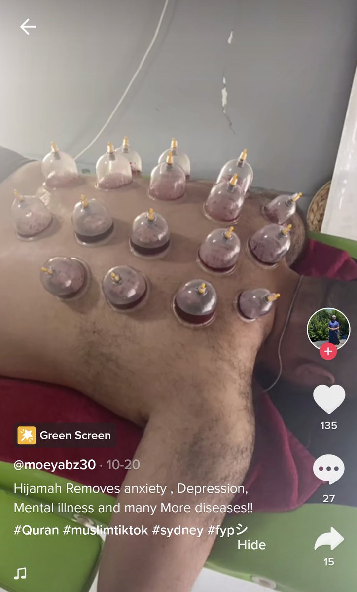 InfidelNoodle's tweet image. As a qualified and experienced mental health professional, I just want to say that there is NO credible evidence whatsoever to suggest that hijama (also known as "cupping therapy") will "remove mental illnesses".