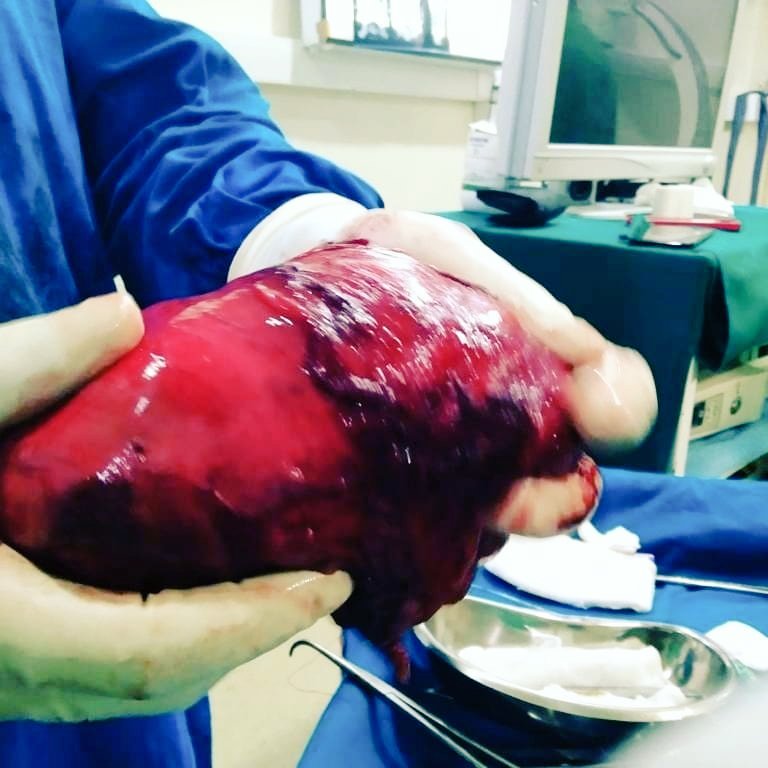 ipitoi's tweet image. How large RCC u do lap radical nehrectomy??