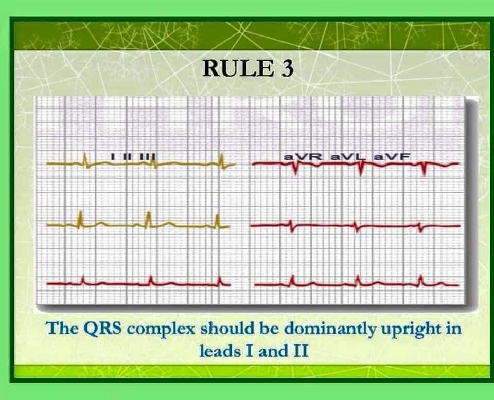 PatologCritica's tweet photo. Las 10 Reglas del Profesor Chamberlain para la Interpretación del #ECG Normal!!!
Aquí las 3 primeras Reglas!!!
Sigue el Hilo para ver las otras 7!!!
👇👇👇👇👇👇👇👇👇👇 https://t.co/iC8MWazTvT
