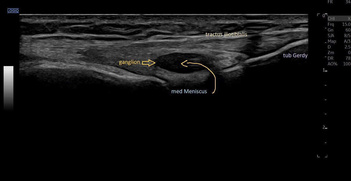 Patient received a meniscal-anchor years ago after lateral meniscus tear - I think this anchor broke loose…. And the medial side shows a meniscal-cyst #mskus #pocus #pocushub #logiqE10r2 #meniscustear