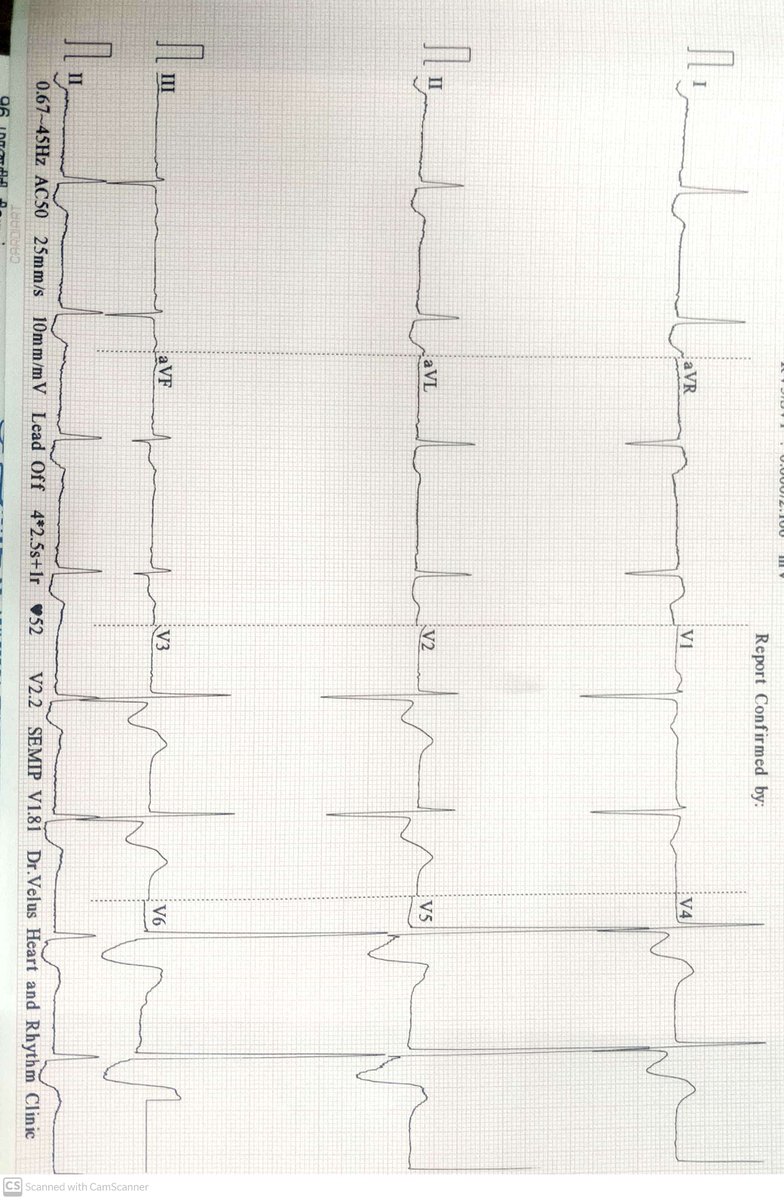 Digitoxicity in a patient with Valvular Cardiomyopathy