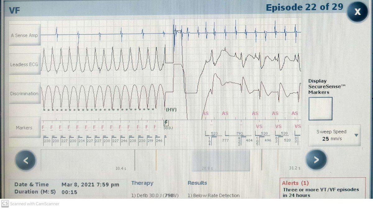 ARVC - Multiple VT episodes
After the shock, VT terminated. Then the patient developed AF but it was undersensed..