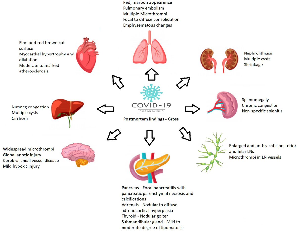 sandralopezleon's tweet photo. 🦠 #COVID Hallazgos Post-Mortem
➡️COVID-19 tiene efectos macroscópicos, histológicos, microscópicos e inmunohistoquímicos en múltiples órganos
➡️Se encontró ARN viral en muchos órganos
➡️COVID-19 está asociado con coagulopatía
🚨 NO ES UNA SIMPLE GRIPA

https://t.co/67dsGSSM80 https://t.co/a5r7csGKbM