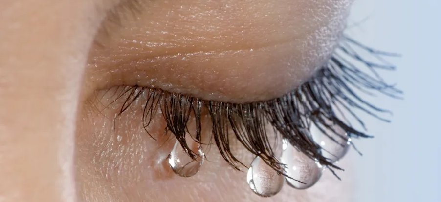 UshaDiamonds's tweet photo. An overflow of tears onto the face, other than caused by normal crying. Epiphora happens when tear film and ocular surface problems rather than by anatomical obstruction of lacrimal drainage.
https://t.co/zDT0sqbNk6 https://t.co/GH7r2ABzB6
