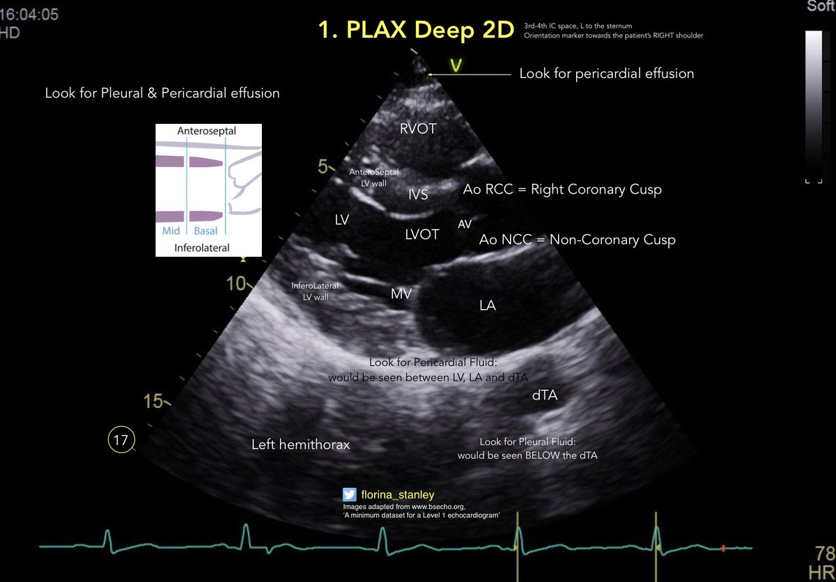 1/18 annotated <a href="/bsecho/">BSEcho</a> Minimum DataSet images for Level 1 BSE Echo <a href="/firstecho/">Moon Sung Eun</a> starters. Images from bsecho.org. Zoom for detailed annotations. <a href="/POCUS/">pocus</a> <a href="/IMPOCUSFocus/">IM POCUS Focus</a> <a href="/GeneralistUS/">Ultrasound For The Generalist</a> <a href="/pocusfoamed/">PoCUS FOAMed</a> #MedEd 1. PLAX Deep 2D