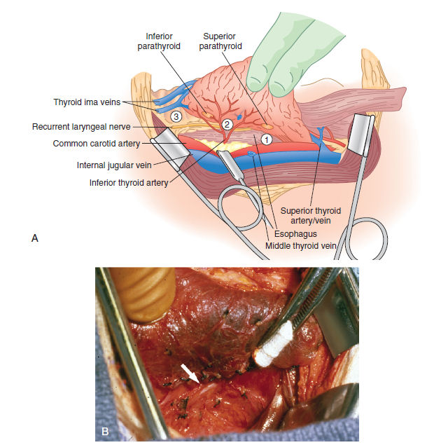 DrJonnys's tweet photo. Commonest Sites Of Injury To RLN “Recurrent Laryngeal Nerve” During Thyroidectomy⁦⤵️⁩
⁦1️⃣⁩ During thyroidectomy, the RLN is at greatest risk forinjury at the ligament of Berry
⁦2️⃣⁩ During ligation of branches of the inferior thyroid artery 
⁦3️⃣⁩ At the thoracic inlet https://t.co/UbPZqtBmVo