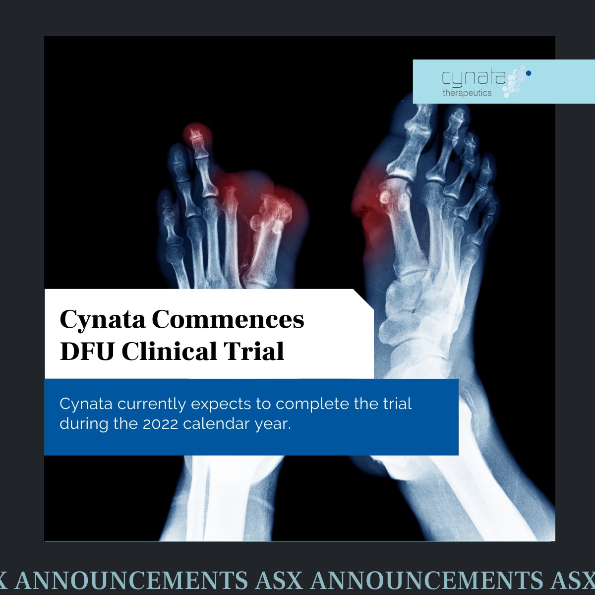 cynatastemcells's tweet photo. Commencing the first human trial is a major milestone in the development of any new product, and we are pleased to have achieved this for our diabetic foot ulcers (DFU) program prior to the end of the year as projected. 

Read more: https://t.co/W91gEjPRpU https://t.co/NioLn5GP90