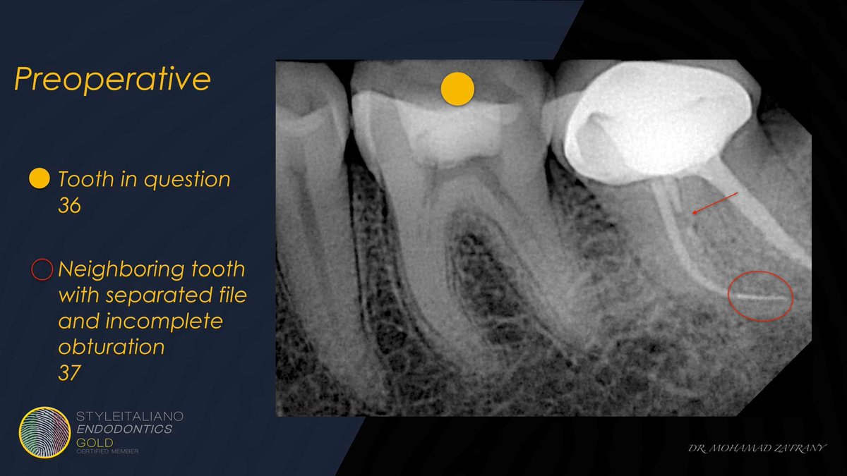 Mia75503607's tweet photo. A referred case for RCT of tooth no.36, After locating the canals, Preflaring done using Fanta #AFFOne 25-06 in the coronal portion.
Glide path managed using K files size 8,10 from Fanta. Canals enlarged to size 25-04 AF FOne.
Case courtesy of Dr. Mohammed Za'frany!
#Fantadental https://t.co/tlV0JqRAeB