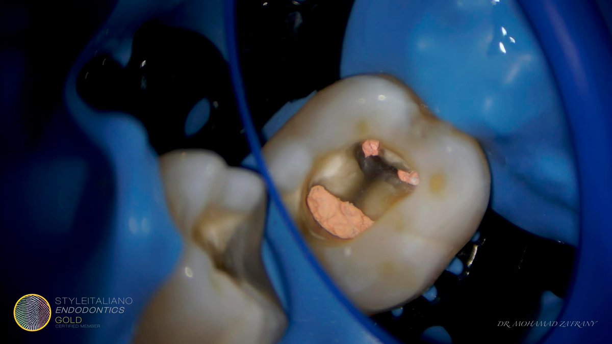 Mia75503607's tweet photo. A referred case for RCT of tooth no.36, After locating the canals, Preflaring done using Fanta #AFFOne 25-06 in the coronal portion.
Glide path managed using K files size 8,10 from Fanta. Canals enlarged to size 25-04 AF FOne.
Case courtesy of Dr. Mohammed Za'frany!
#Fantadental https://t.co/tlV0JqRAeB
