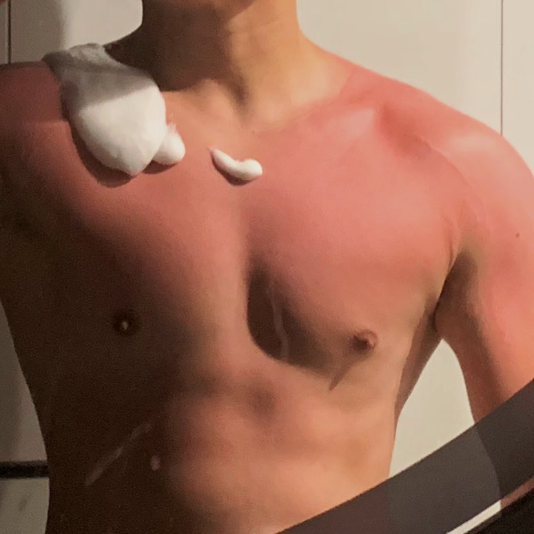 下海游泳真的要防晒👋🏻我已经疼飞了 这镇定喷雾都没用了