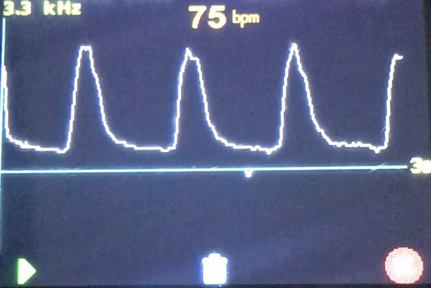 Martinfox2000's tweet image. Colleagues, leaders, managers, podiatrists! What would it take.. to turn EVERY podiatrist consultation / contact.. with people aged 40+.. into a simple opportunity for early detection of life &amp;amp; limb-threatening disease.. in just 30 seconds? 🤔🦵🫀@SuzanneRastrick @BeverleyHarden